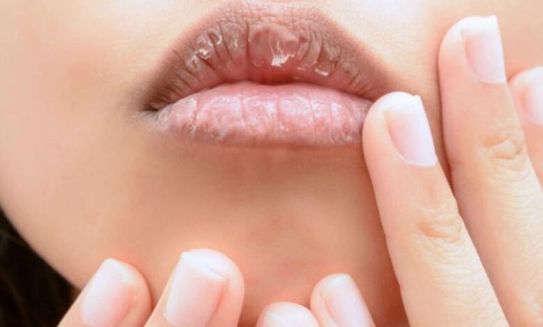Cara alami atasi bibir kering sesudah itu pecah-pecah agar tampil percaya diri